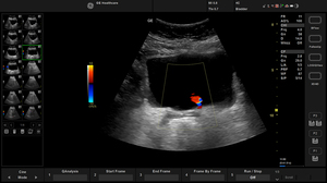 balance-4c-bladder-color_1.jpg