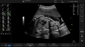 balance-4c-fetal-echo-sri_1.jpg