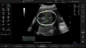 balance-ob-fetal-measurements2_1.jpg