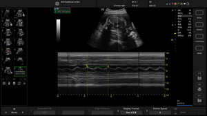 balance-ob-mmode-fetal-hr_1.jpg