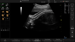 balnce-ob-fetal-spine_1.jpg