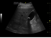 gal-bladder.png