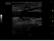 lower-extremity-vein-2.png