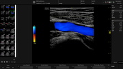 lower-extremity-vein-color-doppler-2.jpg