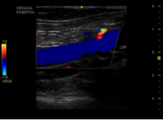 lower-extremity-vein-with-color-doppler.png