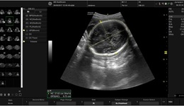 SonoBiometry